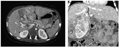 Case Report: ALPPS hepatectomy, an alternative to liver transplantation in central PRETEXT III hepatoblastomas: a case series